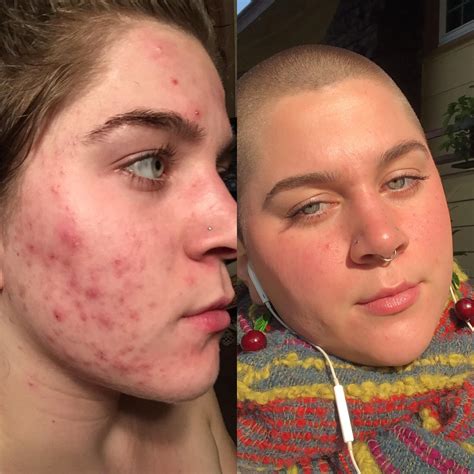 r/SkincareAddiction on Reddit: [acne] My pimples are almost .